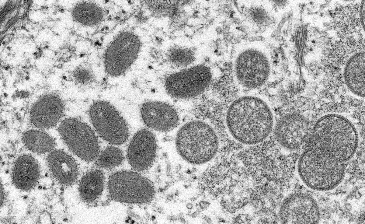 Monkeypox Outbreaks around the World: The Promise of AI and Agile Public Healthcare Analytics Approaches for Global Good
